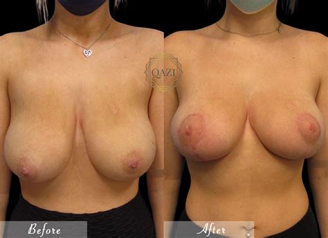 Options For Breast Lift Everything You Need To Know