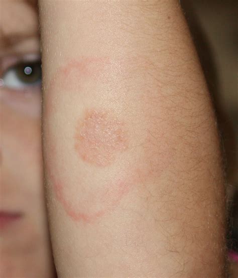 Filelyme Disease Rash On 5 Year Old Wikimedia Commons