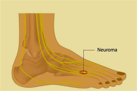 Neuropathy Foot Nerve Pain Treatment Podiatrists In Hartford And Rocky