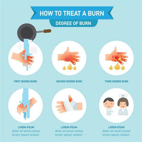 How To Treat A Burn Infographicvector Illustration 3239982 Vector Art