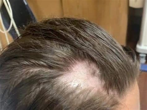 Hair Removal Cream In Tampered Conditioner Makes Woman Go Bald Photo Au — Australia
