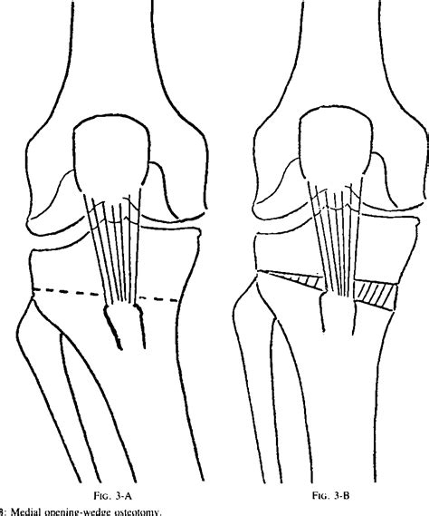 Figure 3 From Proximal Tibial Osteotomy For Osteoarthritis With Varus