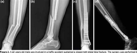 The tibia and fibula fracture can be told perfectly by an orthopedic doctor and a. Figure 2 from Surgical treatment of distal tibia fractures ...