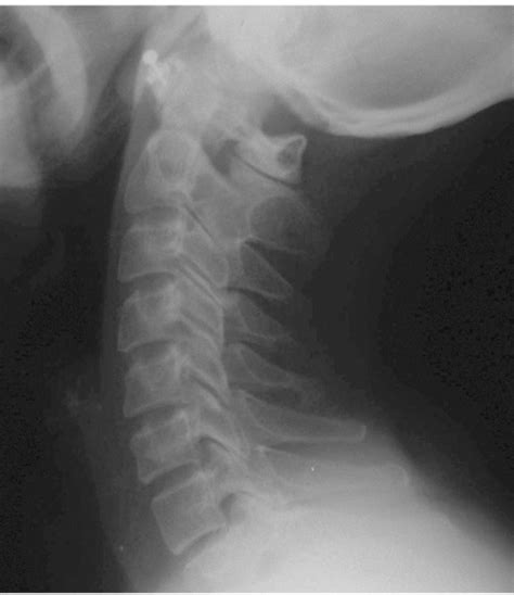 Lateral Cervical Radiograph Showing A Bony Lesion In The Posterior Arch