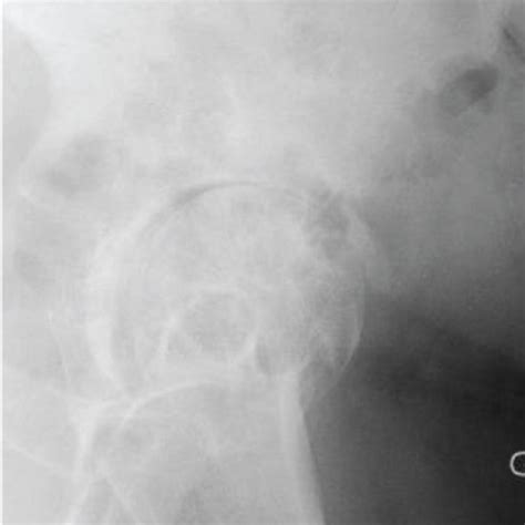 A Pelvic Ap Radiograph With Left Hip Osteoarthritis B Lateral Left