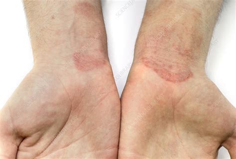 Contact Dermatitis On The Wrists Stock Image C0166863 Science