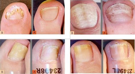 Be it a toenail fungus or fingernail fungus, it is very painful and embarrassing to deal with it. Home Remedies For Toenail Fungus | ThatViralFeed