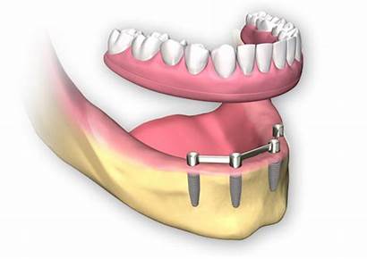 Dental Implants Arch Implant Removable Denture Supported