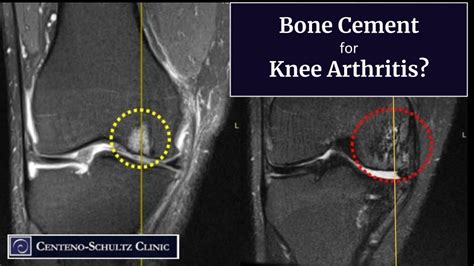 Does Bone Cement Injection Work For Arthritic Knees