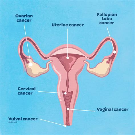Top 9 What Are The Symptoms Of Gynecological Cancer 2022