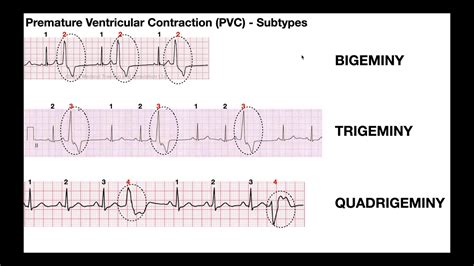 Ekg Patterns Premature Atrial And Ventricular Contractions Pacs And Pvcs