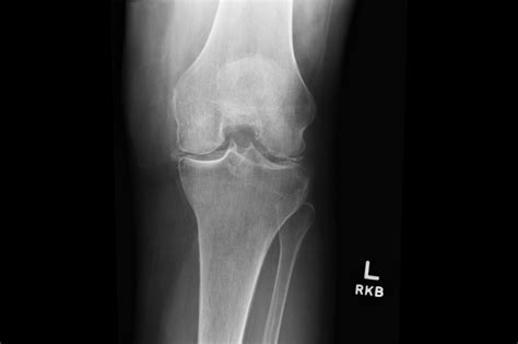 Ortho Dx Recurrent Pain And Swelling In The Knee Clinical Advisor