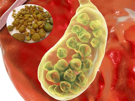 Sticky Meshworks Of Dna And Neutrophils Drive Gallstone Formation