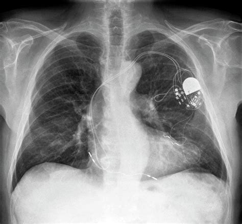 Heart Pacemaker Photograph By Zephyrscience Photo Library Pixels