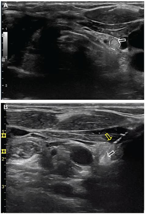 Ultrasound Identification Of Normal Parathyroid Glands Samuel M