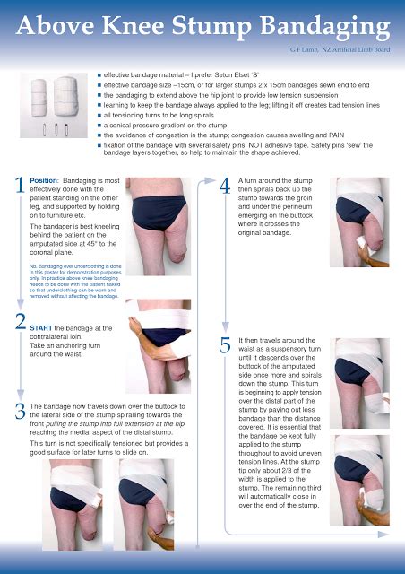 Exclusive Physiotherapy Guide For Physiotherapists Stump Bandaging For