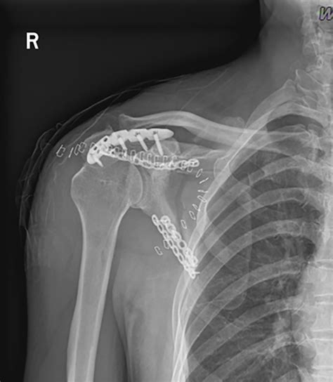 Fracture Of The Scapular Neck Combined With Rotator Cuff Tear A Case