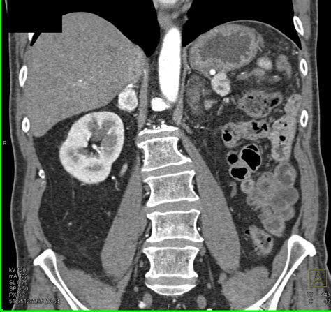 Metastatic Renal Cell Carcinoma To Right Adrenal Gland Adrenal Case