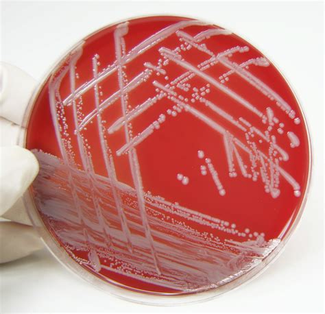 Lupus Risk Associated With Chronic Exposure To Staph Staphylococcus