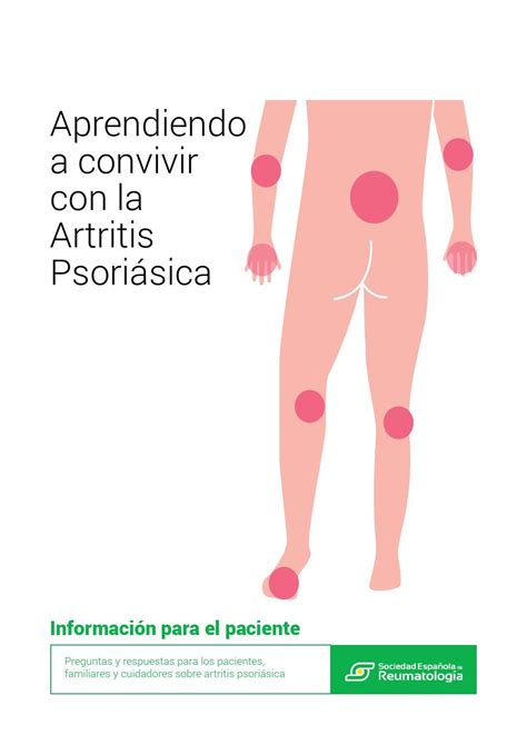 Aprendiendo A Convivir Con La Artritis Psoriásica By Piricanta Issuu
