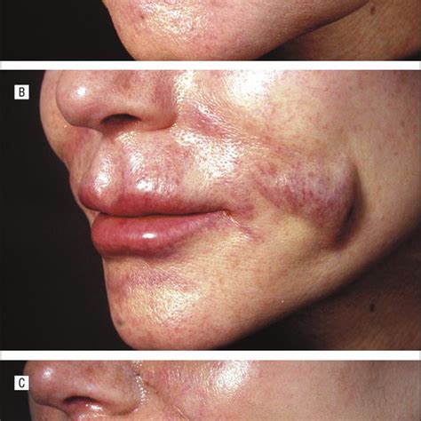Lumps In Lips 6 Months After Filler