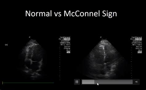 Mcconnell Sign Mcconnell Pulmonary Embolism Bmj Casereports Image Fluent