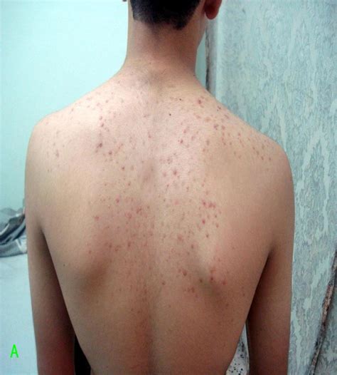 Patient With Pityrosporum Folliculitis A Before Treatment With
