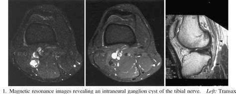 Figure 1 From Recurrent Intraneural Ganglion Cyst Of The Tibial Nerve