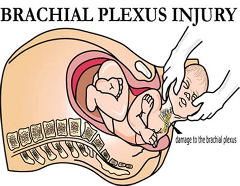 Birth of a baby with a disability resulting from birth. Brachial Plexus Palsy | Classification Of Paralysis Injury