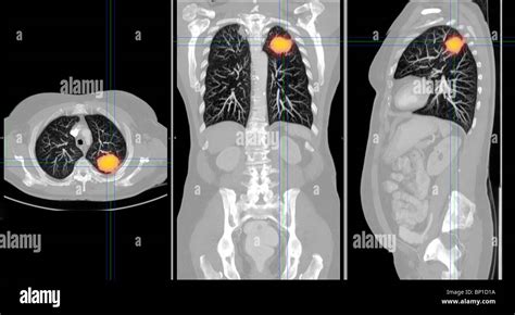 CT Scan Axialer Abschnitt Zeigt Einen Krebs In Der Rechten Lunge Eine