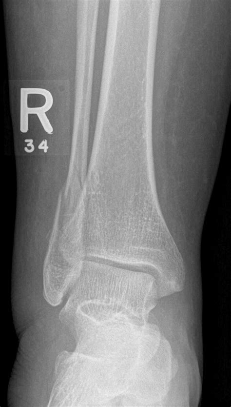Ankle Fracture Weber C Image