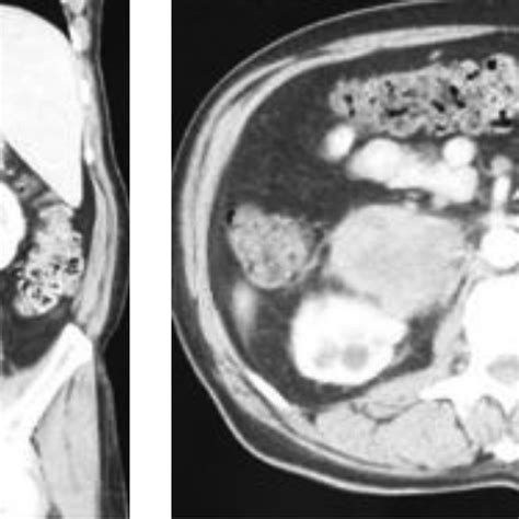 Abdominal Ct Scan Showing Large Bilateral Adrenal Masses Download