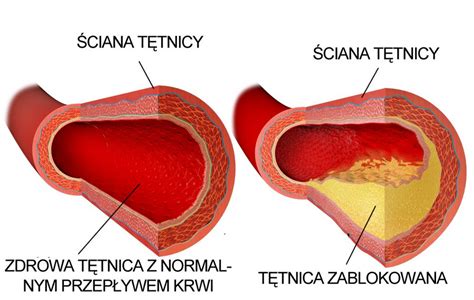 Choroba Takayasu Objawy I Leczenie Zapalenia T Tnic Tvn Zdrowie