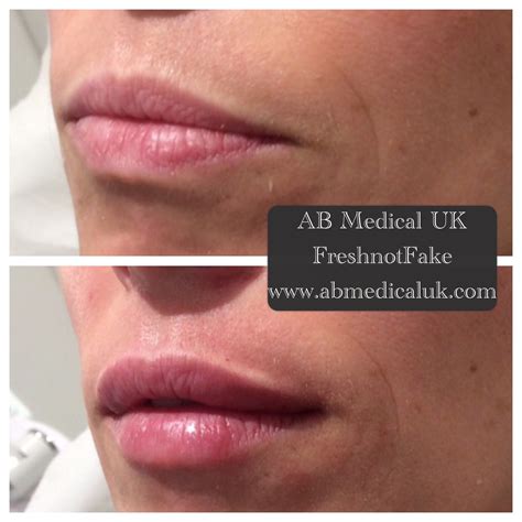 Before And After 055ml Juvederm Ultra Smile Lip Injection Lip