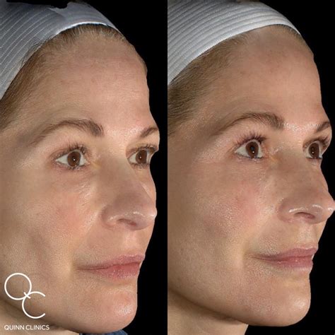 Morpheus8 Microneedling And Radiofrequency Quinn Clinics