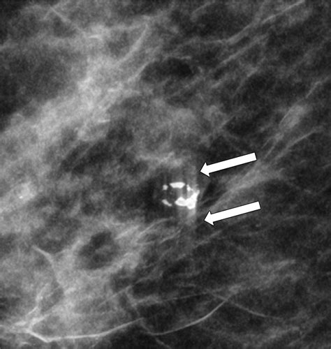 Calcifications At Digital Breast Tomosynthesis Imaging Features And