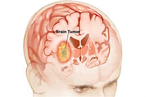 Or, the cause of a symptom may be a different medical condition that is not. What is Brain Tumor Surgery Cost in India | Top 10 Brain ...