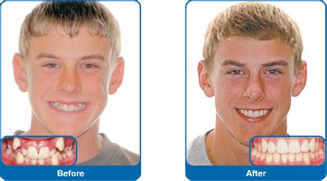 Damon Braces Before And After Bahamas Orthodontic Center Nassau