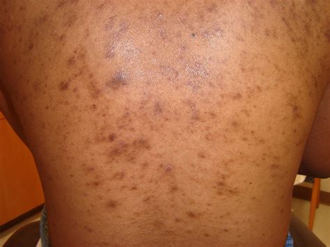 Post Inflammatory Hyperpigmentation And Hypopigmentation Post