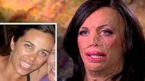 What Happened To Turia Pitt Accident Video And Before Photos Details
