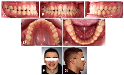 Medicina Free Full Text Treatment Of Class Iii Malocclusion And