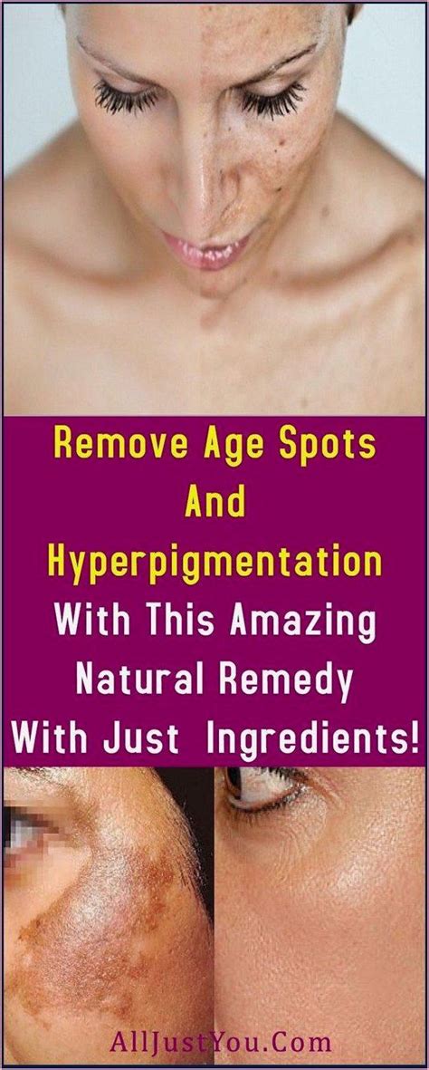 Remove Age Spots And Hyperpigmentation With This Amazing Natural Remedy
