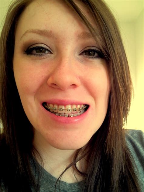 How can you fix it with braces and surgery? My Jaw Surgery: November 2011