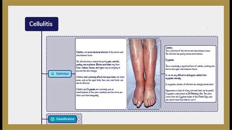 Cellulitis Causes Symptoms Management Youtube