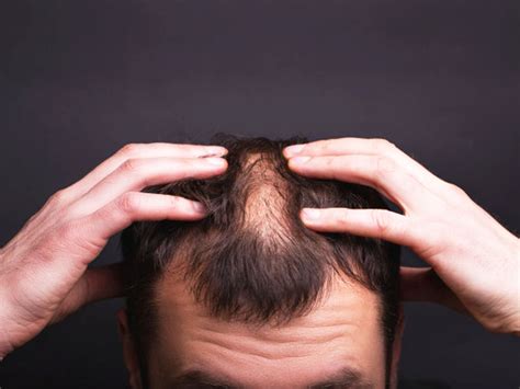 Psoriasis And Hair Loss Causes Symptoms And Treatment