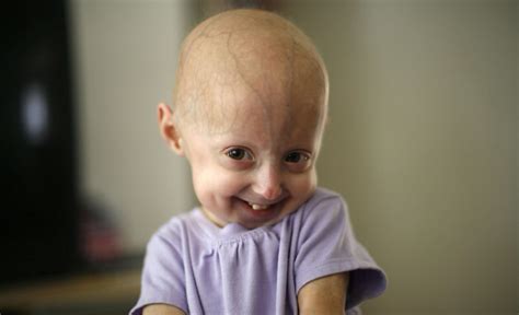 Progeria Disease Facts