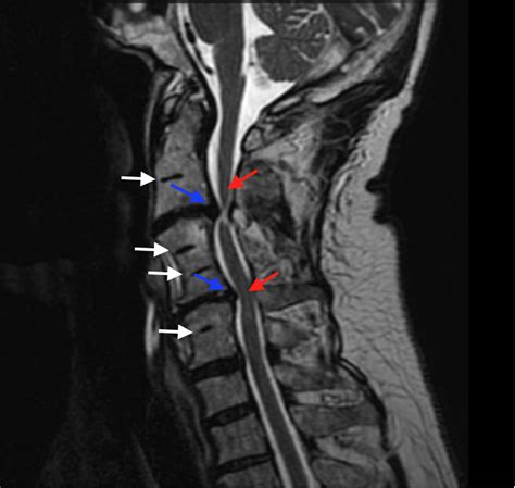 Cureus Images In Spine A Rare Abnormal Bony Fusion