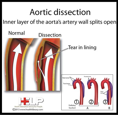 Aortic Dissection Aortic Dissection Nurse Cardiac Nursing