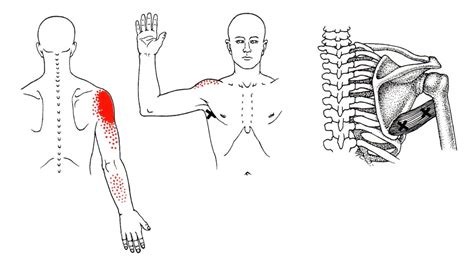 Teres Major The Trigger Point And Referred Pain Guide