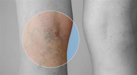 Thread Vein Removal And Treatment Health And Aesthetics